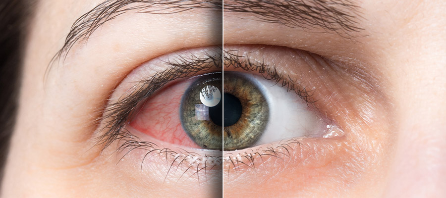 Красные глаза: снимаем усталость органов зрения