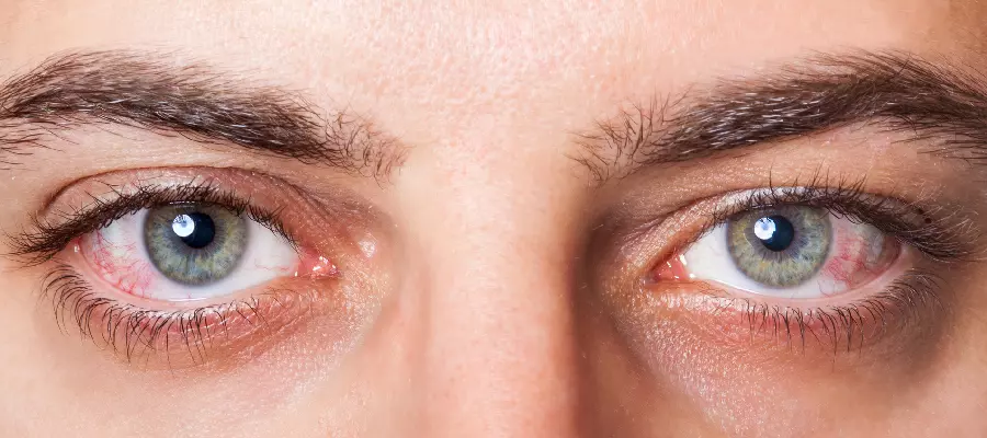 Аллергия на веках глаз: диагностика и лечение аллергии на веках глаз